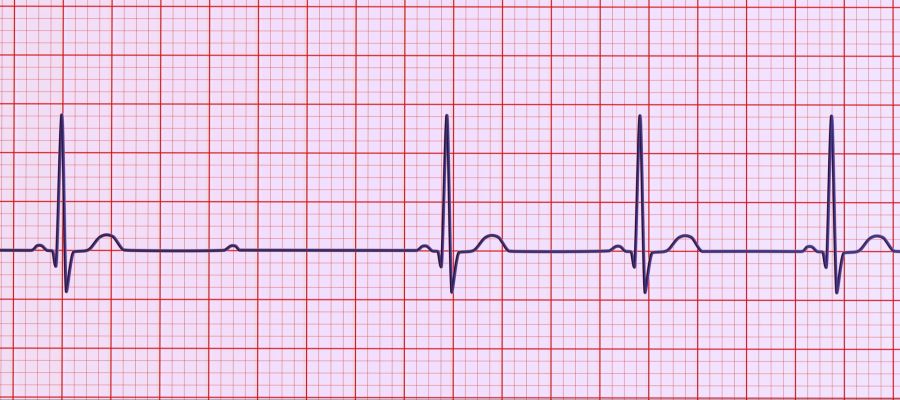 EKG Herz Rhythmus Störung