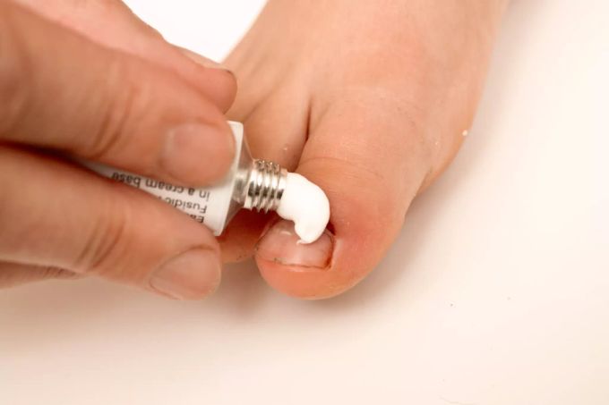Nagelbettentzündung mit einer Creme behandeln. Nagelbettentzündung