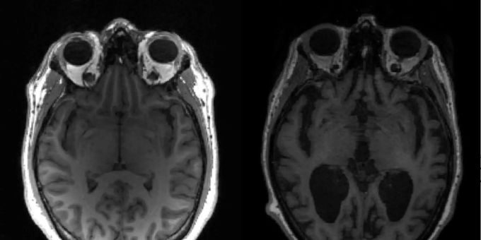MRT-Scan von einem Gehirn mit Alzheimer (r.) und gesundem Gehirn. alzheimer