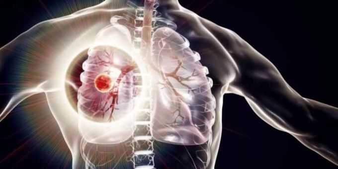 Jährlich erkranken rund zehn Millionen Menschen an der schweren Lungenerkrankung. Tuberkulose
