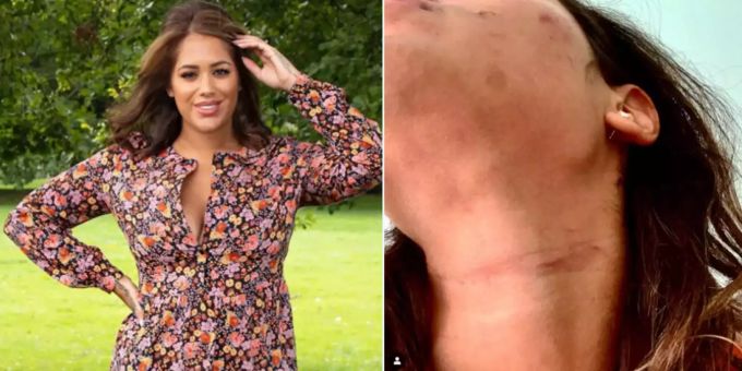 Sie zeigt Fotos - Briten-TV-Sternchen brutal von Ex-Freund verprügelt
