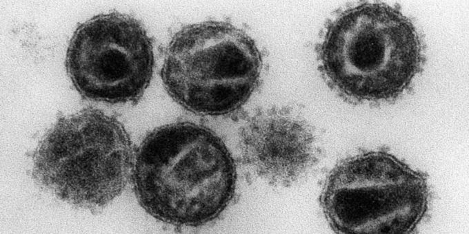 HIV (Aids)-Viren unter einem Elektronenmikroskop. Aids