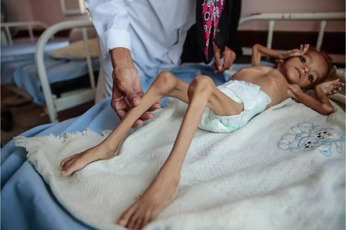 Während in Jemen Kinder verhungern, werfen Industriestaaten ein Drittel der produzierten Lebensmittel wieder weg. Hungersnot im Jemen