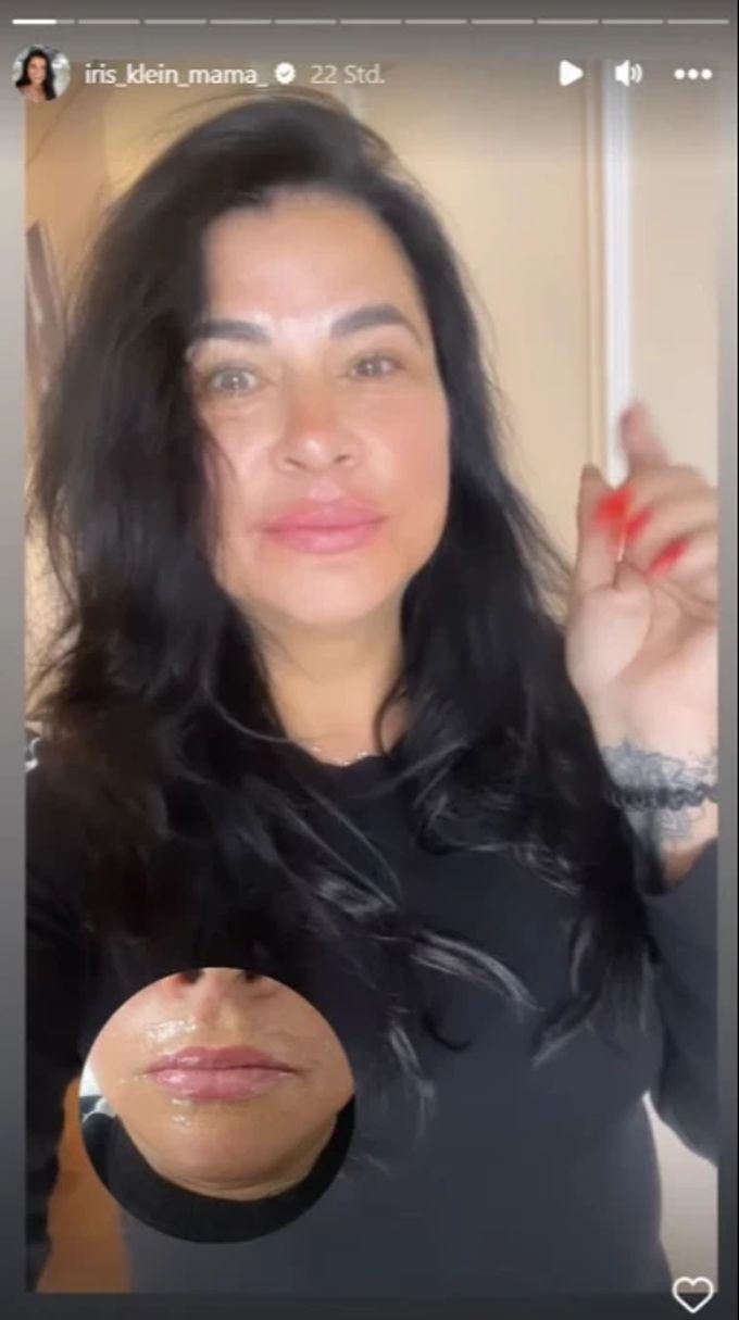 Iris Klein zeigt in ihrer Instagram-Story ihr frühmorgendliches Lippen-Aufspritzen. Daniela Katzenberger