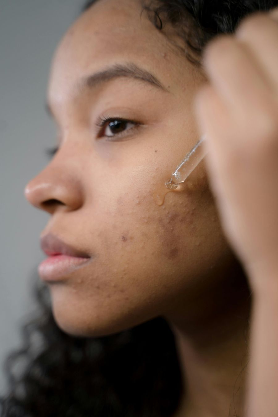 Wenn Akne schlimm ausgeprägt ist oder nicht weggeht, sollte man einen Dermatologen aufsuchen.