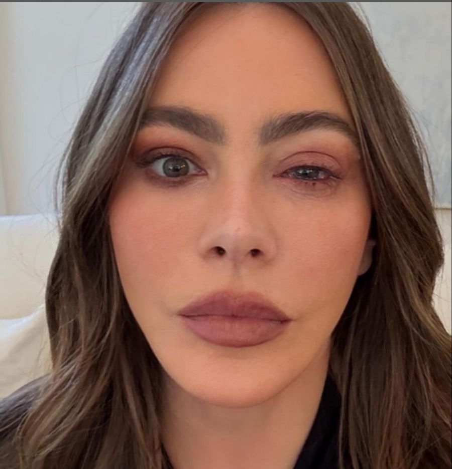 Sofía Vergara linkes Auge ist angeschwollen.
