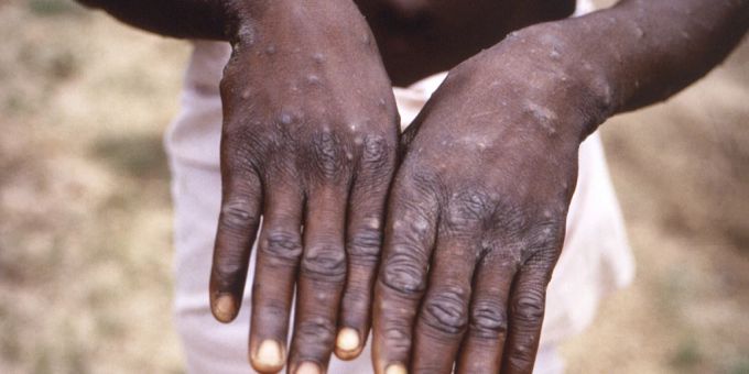 Notlage ausgerufen - WHO fordert wegen Mpox höhere Impfstoff-Produktion
