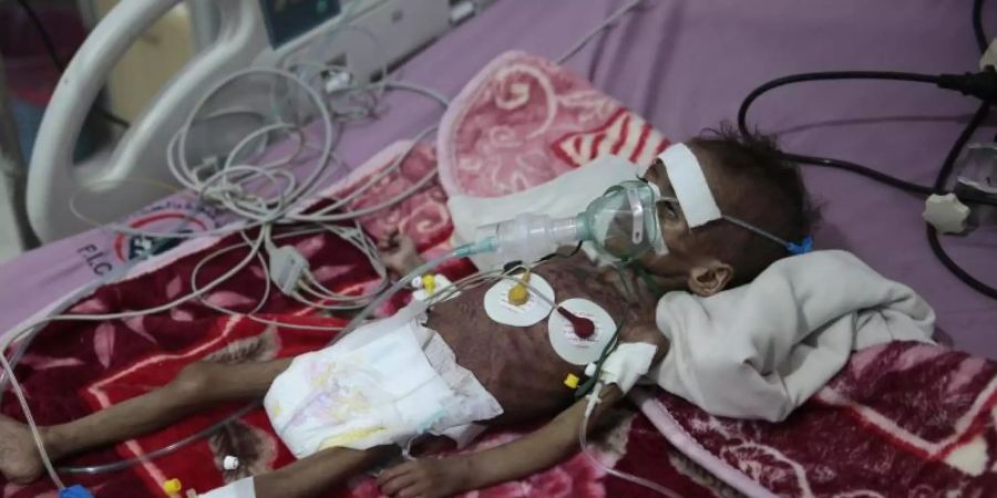 Ein unterernährtes Mädchen wird in einem Krankenhaus im jemenitischen Sanaa behandelt. Foto: Hani Mohammed/AP/dpa