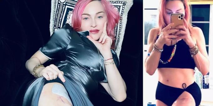 Nach Hüft-OP - Superstar Madonna (62) schockt mit Mega-Narbe