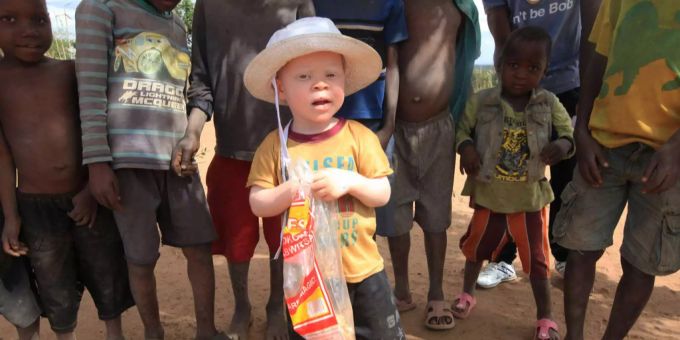 Albinos haben es in Afrika nicht einfach. Aufgrund ihres Aussehens werden sie in manchen Regionen getötet oder entführt. Albinos haben es in Afrika nicht einfach. Aufgrund ihres Aussehens werden sie in manchen Regionen getötet oder entführt.