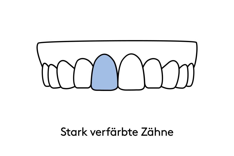 Das kann bestsmile mit Veneers korrigieren.