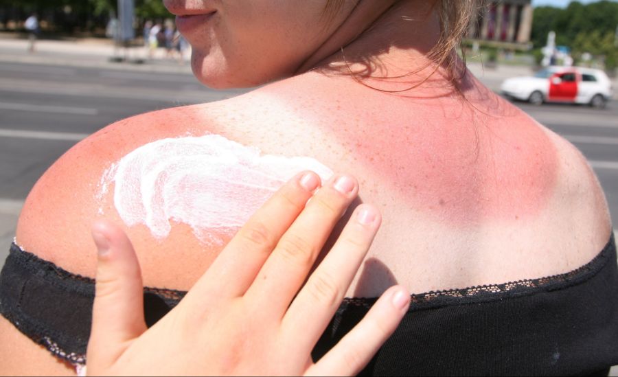 Gefährlich: Schon ein einziger Sonnenbrand kann zu Hautkrebs führen.