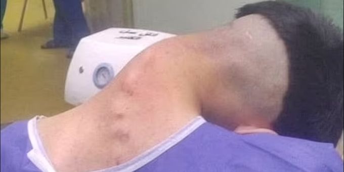 Der Mann litt am «Dropped-head-Syndrom». Dropped Head Syndrom Drogen