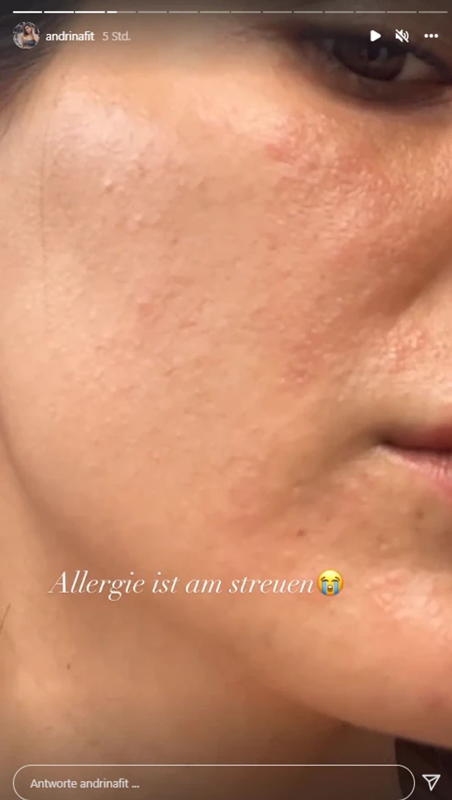 Andrina Santoro zeigt ihre Allergie im Gesicht.