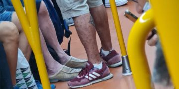 Affenpocken U.Bahn