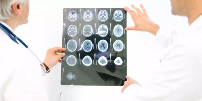 Dank neuer Forschung soll die fühzeitige Diagnose von der Alzheimer-Krankheit massiv vereinfacht werden. alzheimer
