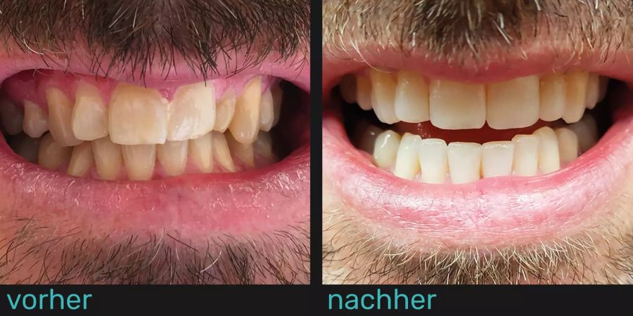 Zähne vor und nach Gebrauch der durchsichtigen Zahnspange.