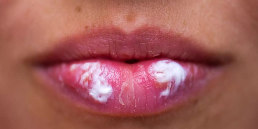 lippen herpes was