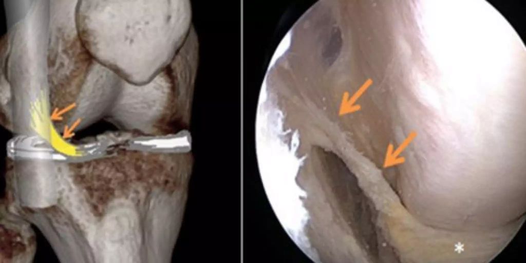 Neues Band am Knie entdeckt