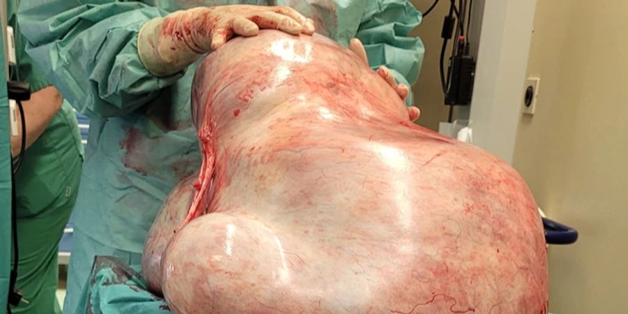 Tumor