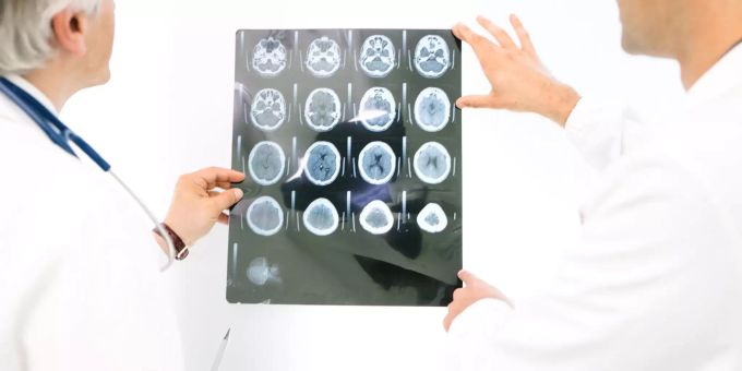 Forschungsdurchbruch? - Bluttest soll Alzheimer-Risiko voraussagen