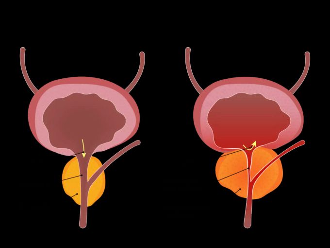 Eine gesunde wie auch eine vergrösserte Prostata Helvilab AG