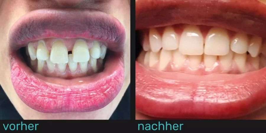 Zähne vor und nach Gebrauch der durchsichtigen Zahnspange.