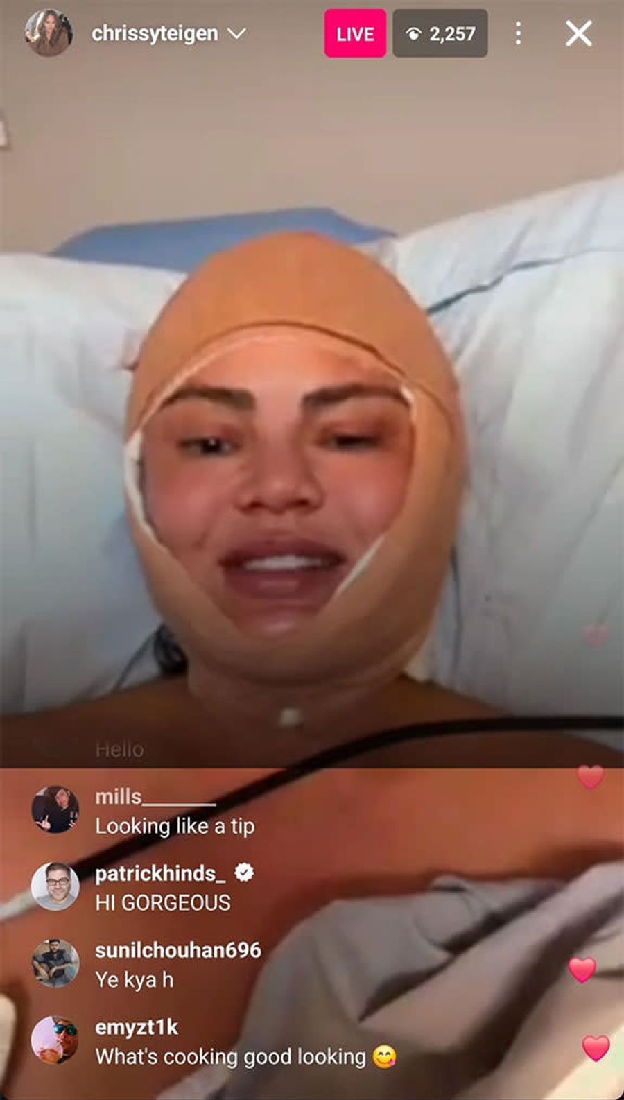 Ungewohnter Anblick: Chrissy Teigen meldet sich vollkommen mit einer Bandage umwickelt bei ihren Fans.
