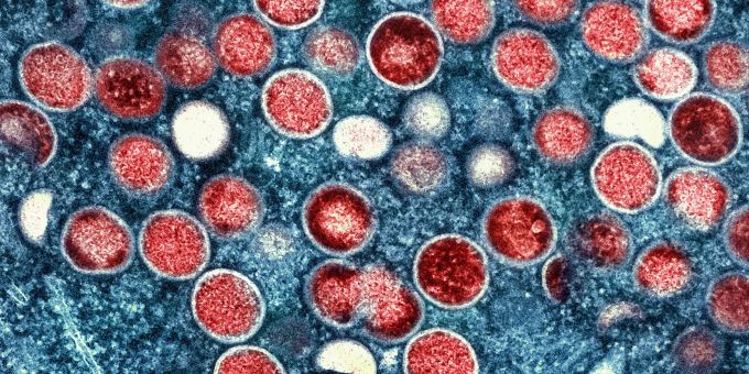 Wegen der Häufung einer neuen Mpox-Variante in Afrika aktivierte die WHO im August 2024 die höchste Alarmstufe. (Symbolbild) Mpox-Variante
