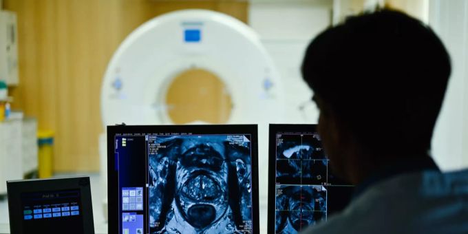 Prostatakrebs wird oft erst spät bemerkt. prostatakrebs