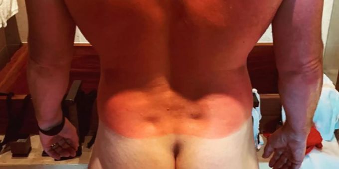 Extrem-Sonnenbrand - «Avengers»-Star Chris Pratt wird zu Crispy Pratt