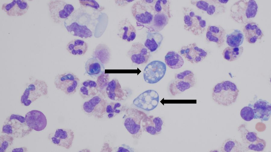 Naegleria fowleri arbeitet sich im Normalfall von den Nasennebenhöhlen bis ins Gehirn vor. Experten gehen von einer Sterblichkeitsrate von 95 bis 99 Prozent aus.
