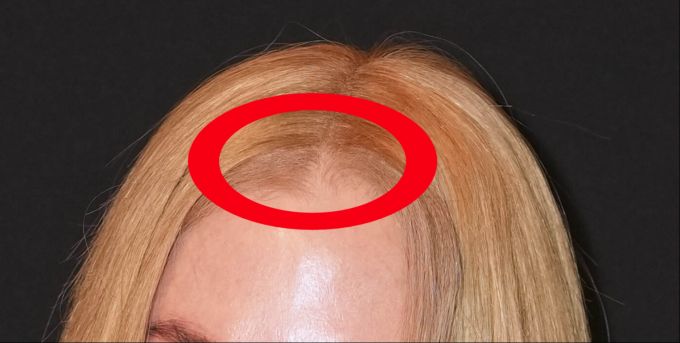 Der Farbunterschied der Haare verrät: Hier ist die Perücke verrutscht. Vorne das echte Haar von Nicole Kidman. Erst nach ein paar Zentimetern beginnt die Perücke. Nicole Kidman