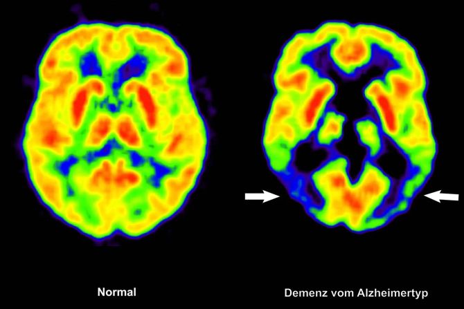 alzheimer