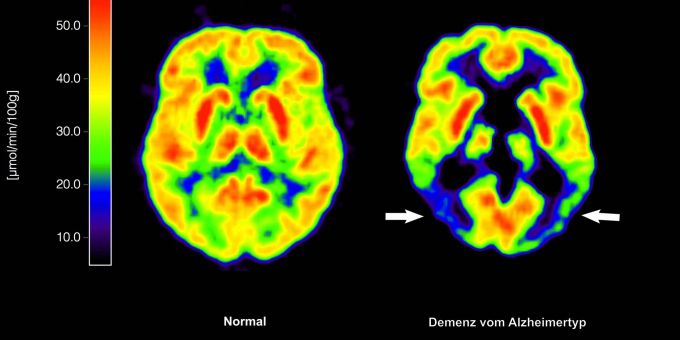 Lecanemab richtet sich gegen Amyloid-Ablagerungen im Gehirn und soll dadurch den Verlauf der Krankheit ein wenig verlangsamen. (Archivbild) Lecanemab