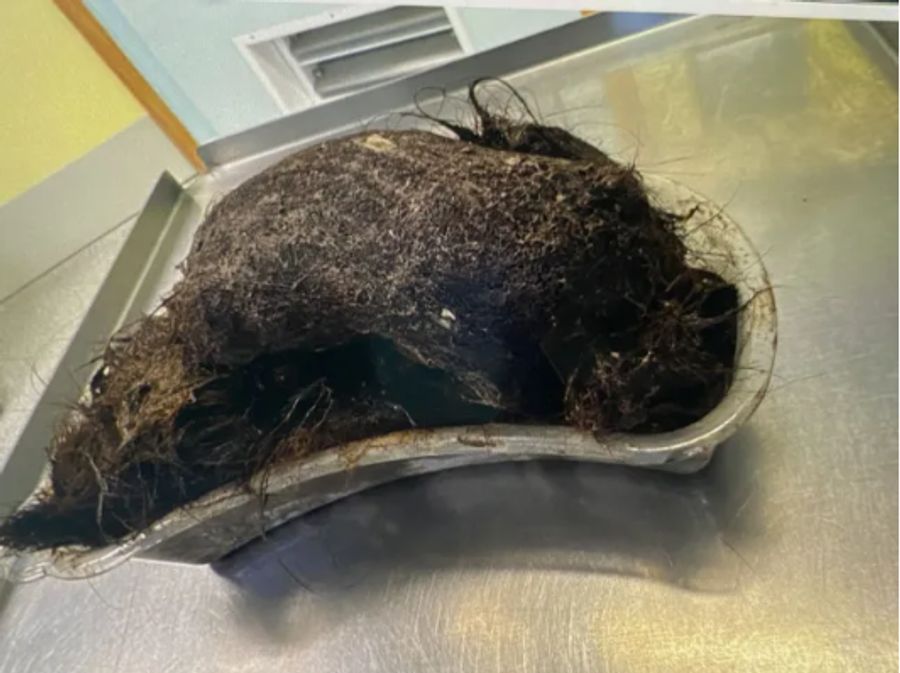 Der ein Kilo schwere Ballen mit der Grösse einer Melone wurde bei einer fünfstündigen Operation entfernt.