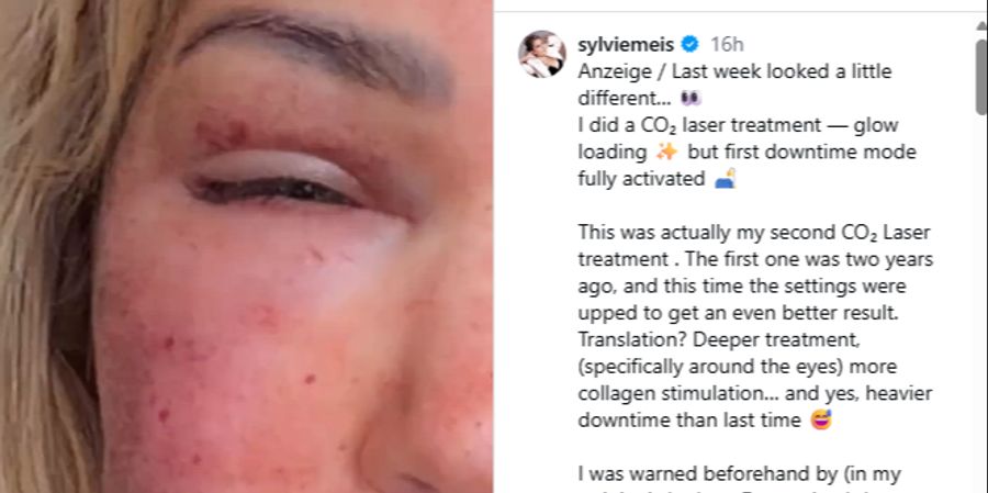 Wegen der Schwellung konnte sie am nächsten Tag die Augen kaum öffnen, schreibt sie auf Instagram.