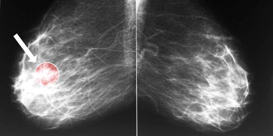 brust x-ray mit auffälligkeit