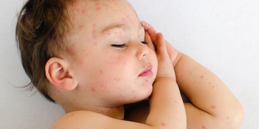 Bei Kindern kann Nesselsucht ähnlich wie andere Hautausschläge aussehen.