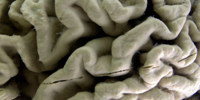 Eine Nahaufnahme eines menschlichen Gehirns, das von der Alzheimer-Krankheit betroffen ist, ausgestellt im Museum für Neuroanatomie an der University at Buffalo. Eine Nahaufnahme eines menschlichen Gehirns, das von der Alzheimer-Krankheit betroffen ist, ausgestellt im Museum für Neuroanatomie an der University at Buffalo.