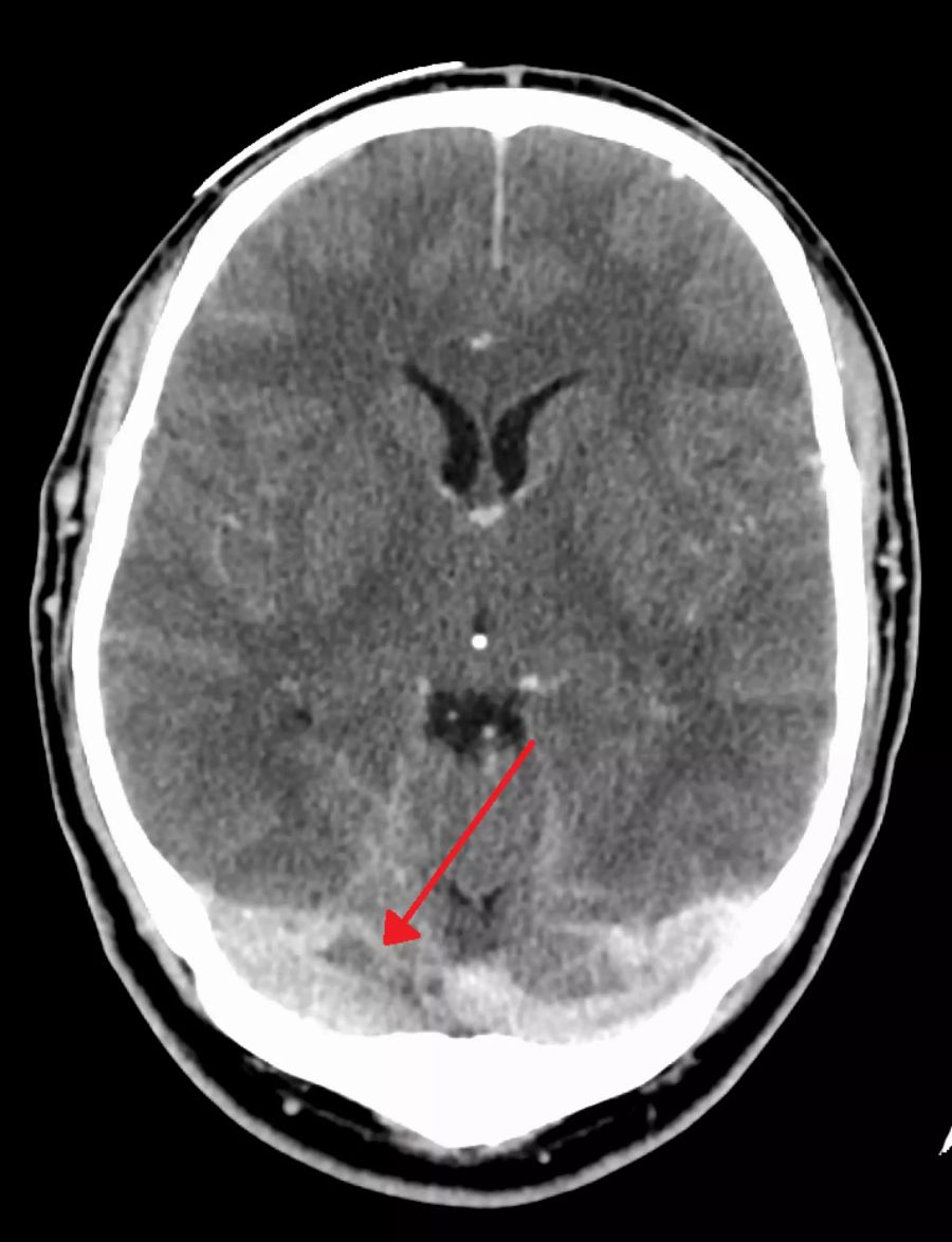 Thrombose AstraZeneca