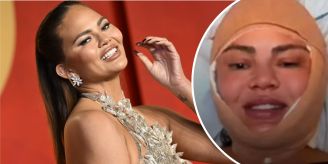 Wegen Haarausfall - Stirn genäht: Krasse Beauty-OP bei Chrissy Teigen