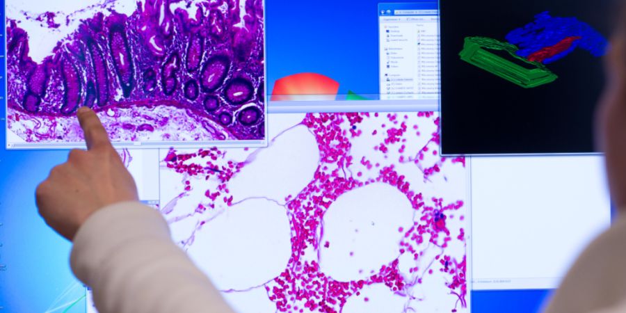 Ein Mitarbeiter zeigt an einem Computerbildschirm auf eine Darstellung einer eingescannten Probe eines Stück Gewebes aus dem Dickdarm, das bei einer Operation entnommenen wurde. (Symbo...