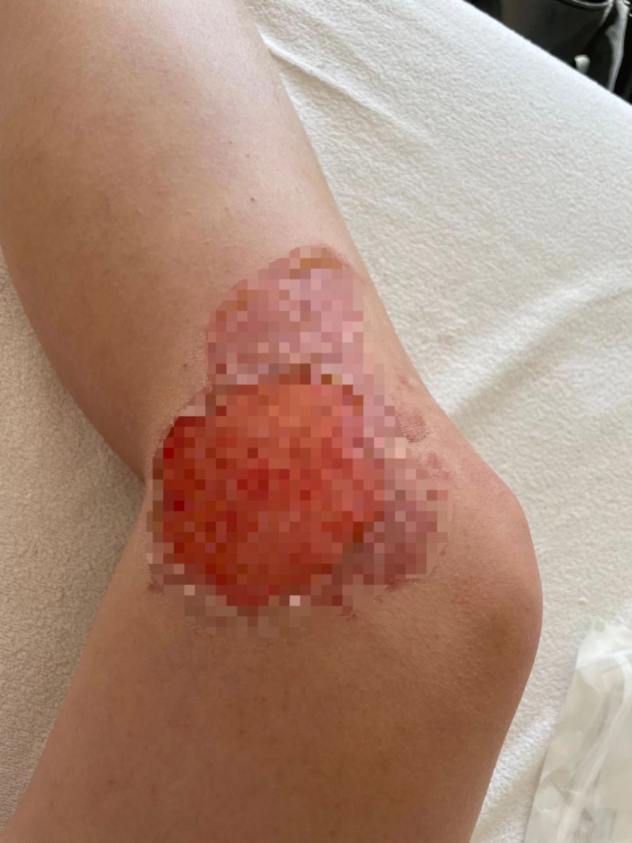 Aurora V. ist die Tasse in der Hand zersprungen, der heisse Inhalt schüttete über ihr Knie.