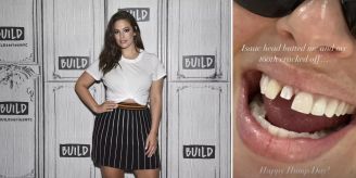 Verheerende Kopfnuss - Ashley Graham verliert wegen Sohn (1) Zahn