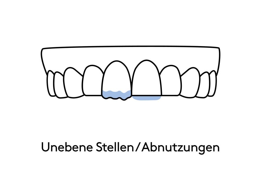 Das kann bestsmile mit Veneers korrigieren.