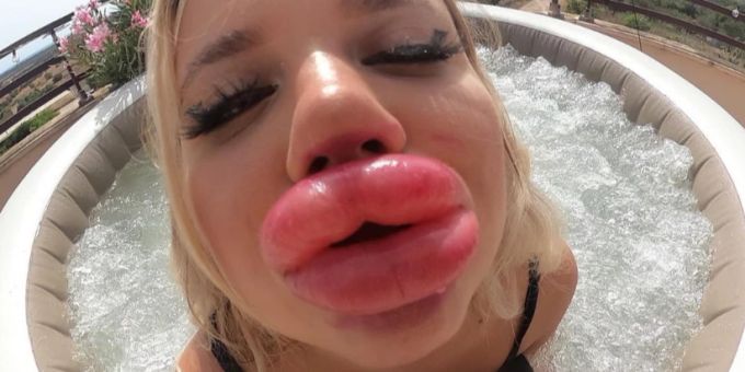 «Nicht gross genug» - Ösi-Influencerin schockt mit XXXL-Lippen
