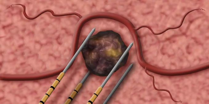 Nadeln werden rund um den Tumor platziert. Nadeln werden rund um den Tumor platziert.