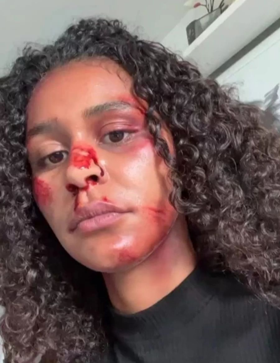Die ehemalige «GNTM»-Kandidatin Lijana schockiert auf Instagram mit einem Foto ihres blutigen Gesichts.