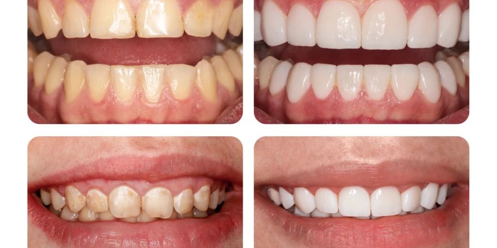 Nie wieder verfärbte Zähne